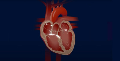 What is Atrial Fibrillation?