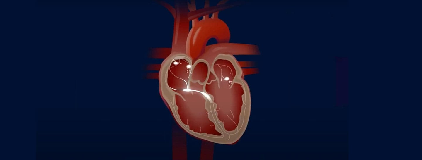 What is Atrial Fibrillation? | DTH